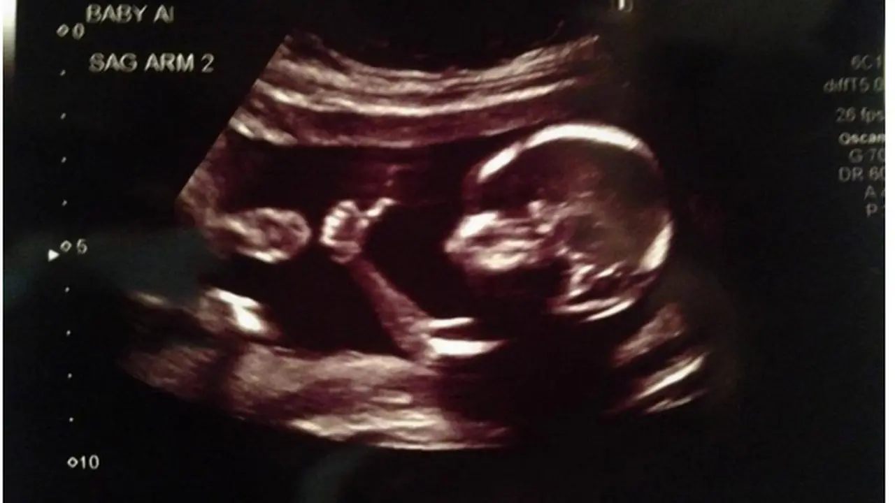 Jempolan! Bayi Ini Pamer Jempol Saat USG