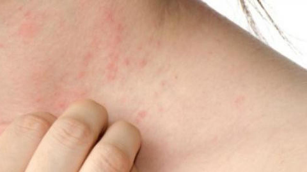 Ini dia 10 isu menarik tentang lupus
