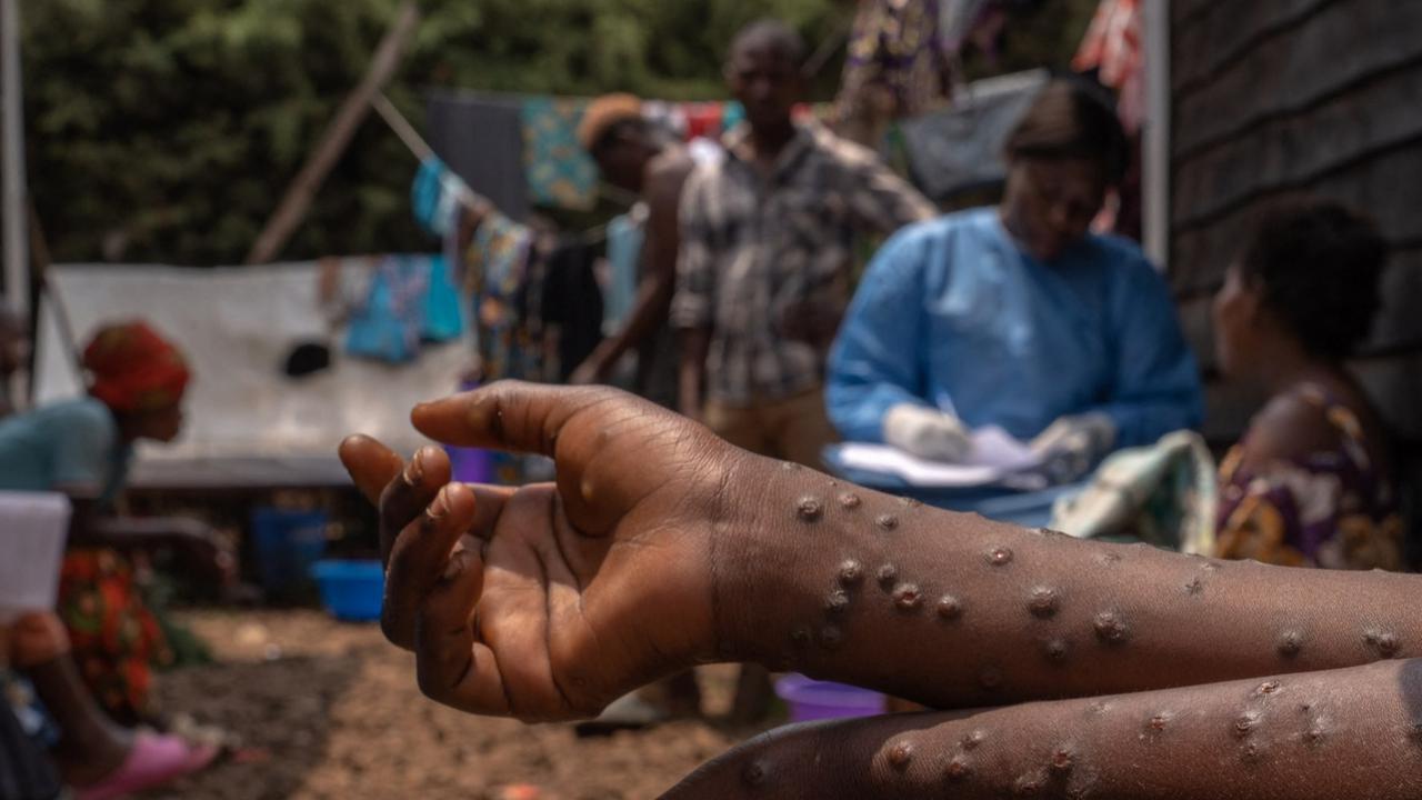 Waspada, Varian Cacar Monyet Lebih Berbahaya dan Mematikan Terdeteksi Pertama Kali di AS