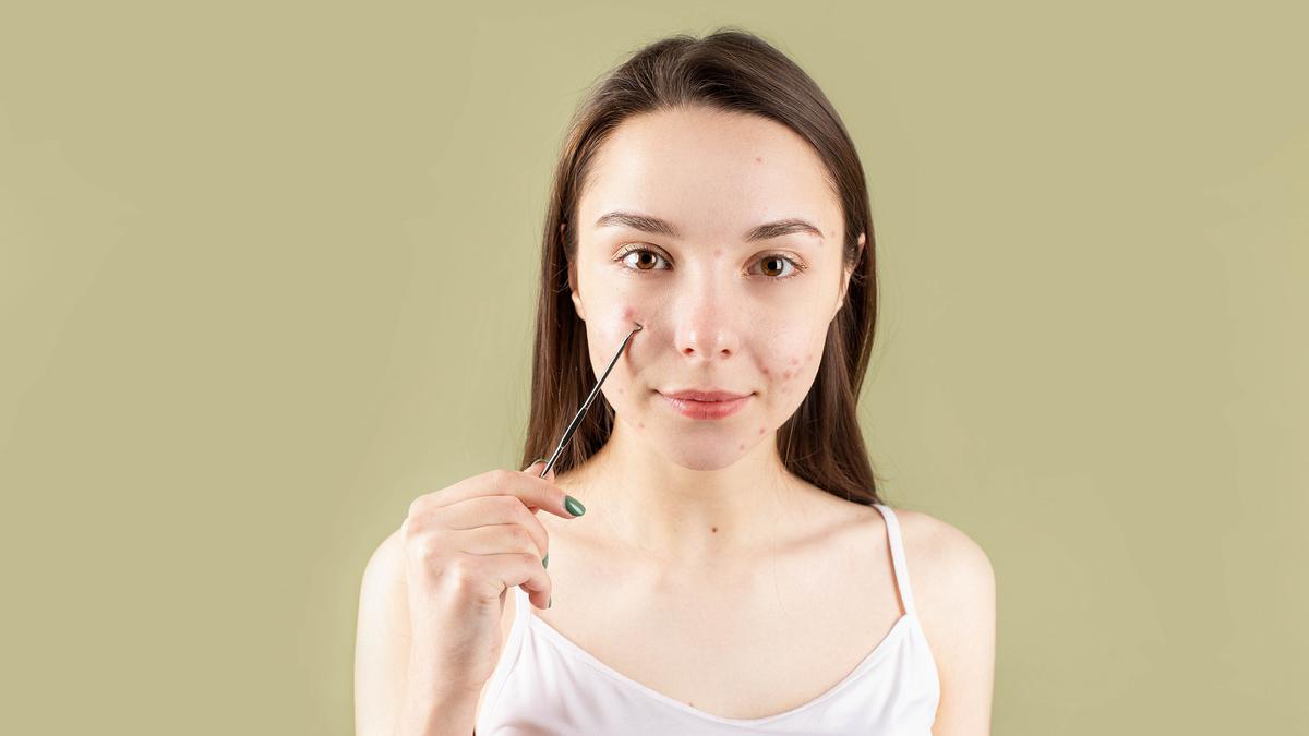 Cara Mencegah Timbulnya Komedo, Hindari 3 Kesalahan Ini - Beauty Fimela.com