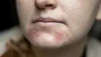 Dermatitis Perioral: Gejala, Penyebab, dan Pengobatan