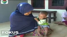 Puluhan balita di Purwakarta, terjangkit Flu Singapura, gejalanya ditandai dengan demam tinggi, kulit gatal-gatal hingga radang tenggorokan.