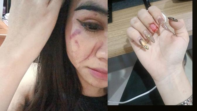 Bella (Ali) Dihajar Rival Transgender, Kuku Copot Gara-gara Kata 'Wandu