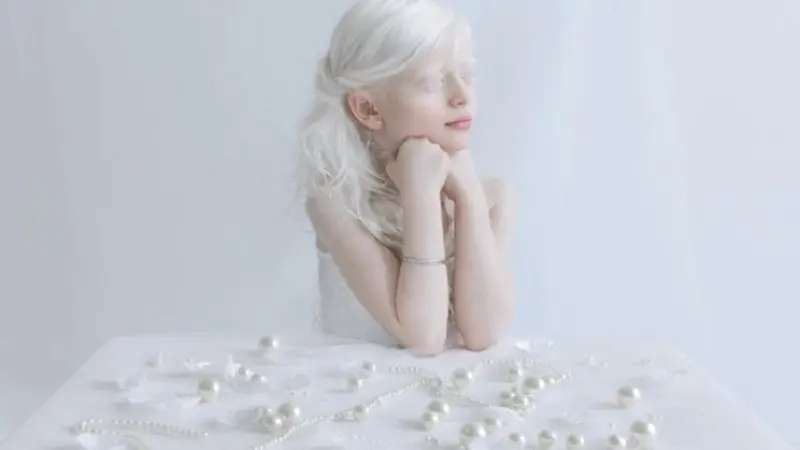 Potret Albinisme dalam Keindahan yang Menakjubkan