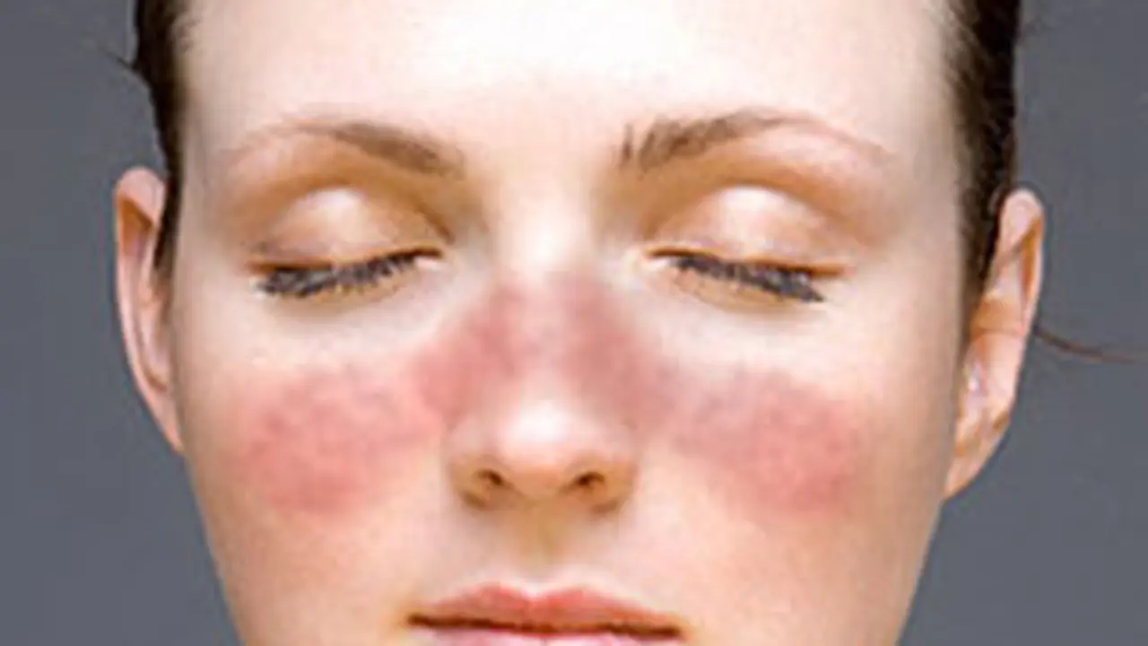 Lupus