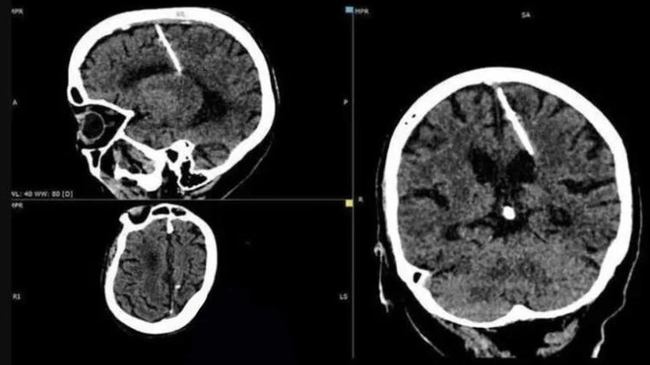 Jarum Tertancap di Otak