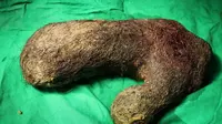 Mengeluh Sakit Perut, Dokter Temukan 1 Kg Gumpalan Rambut