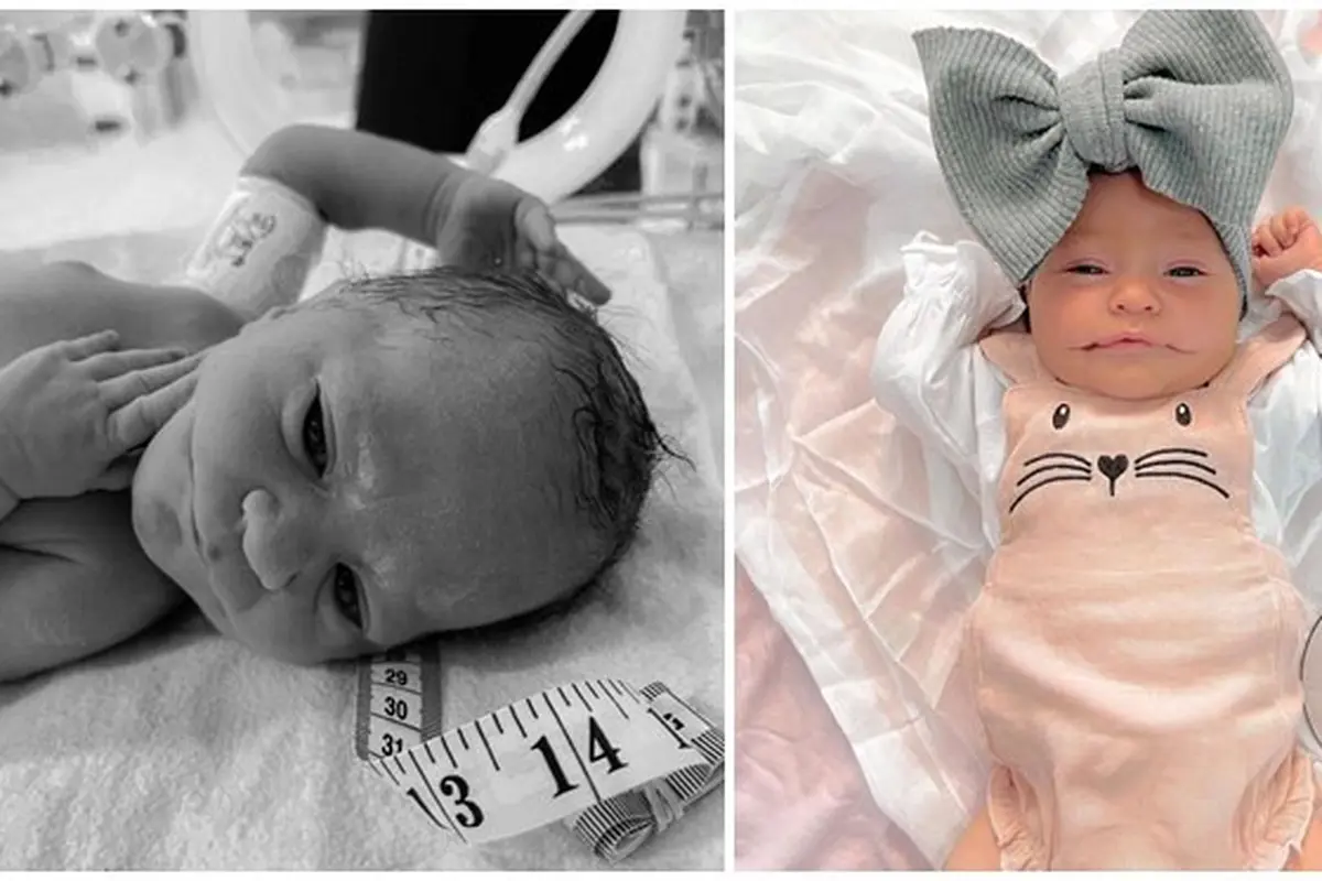 Alami Kondisi Sangat Langka, Bayi Ini Lahir dengan Mulut Selau Tersenyum