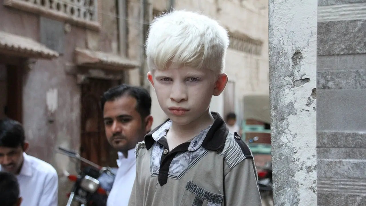 Gangguan Kesehatan pada Orang Albino