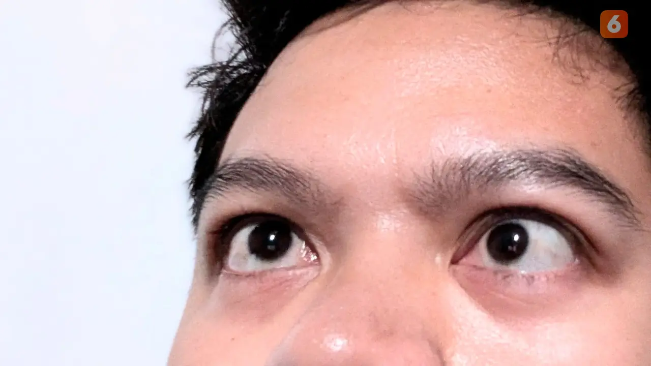 Down Syndrome dan Cerebral Palsy Masuk Daftar Penyebab Mata Juling alias Strabismus
