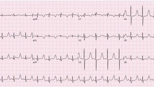 Ilustrasi EKG