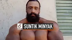 Meski telah diperingatkan dokter tentang risiko menggunakan minyak synthol secara teratur. Namun, Seorang pria di Brasil malah mengabaikannya dan terus menggunakannya secara rutin. Dia bahkan berniat untut menjadikan otot-ototnya lebih besar lagi.