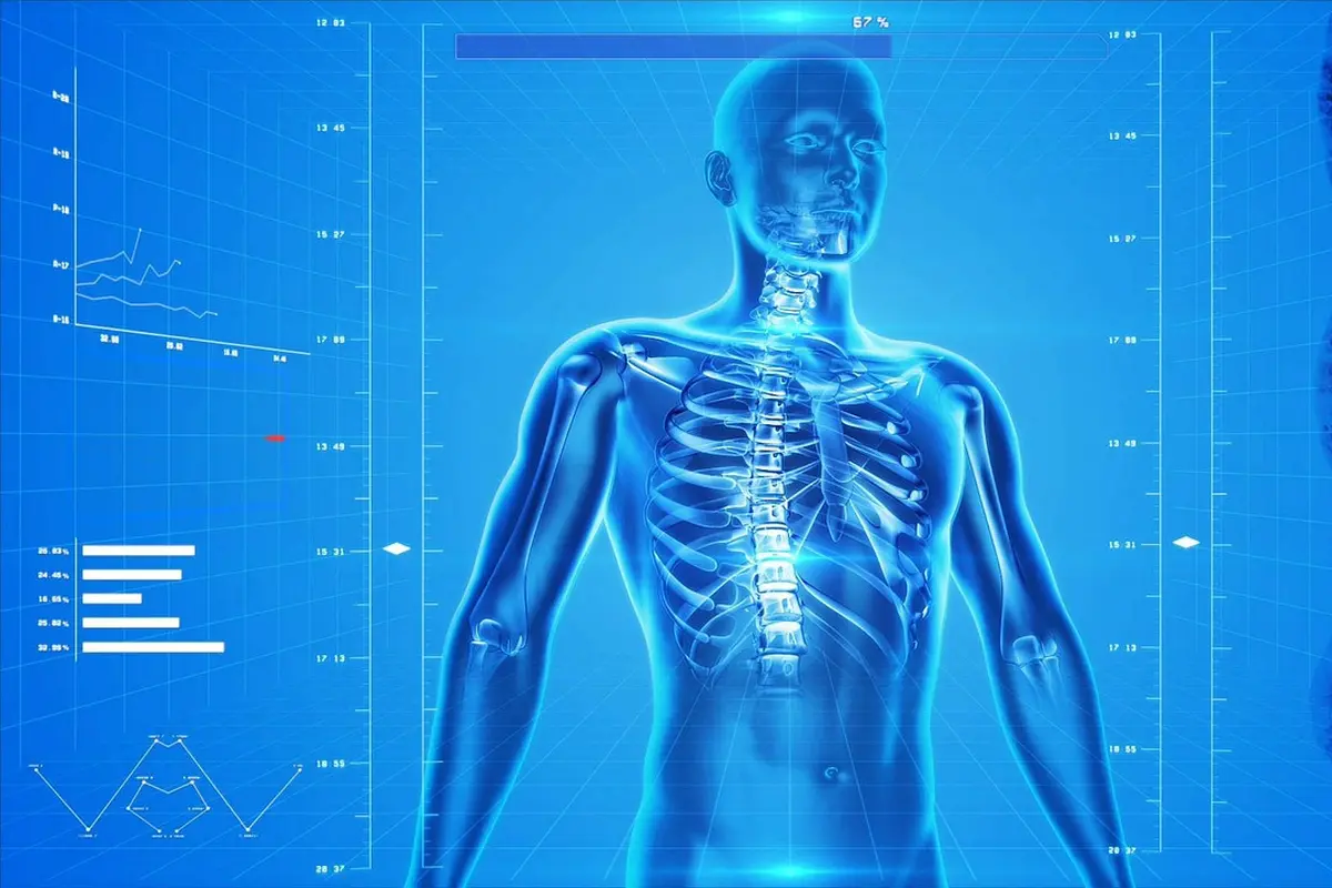 Osteoporosis