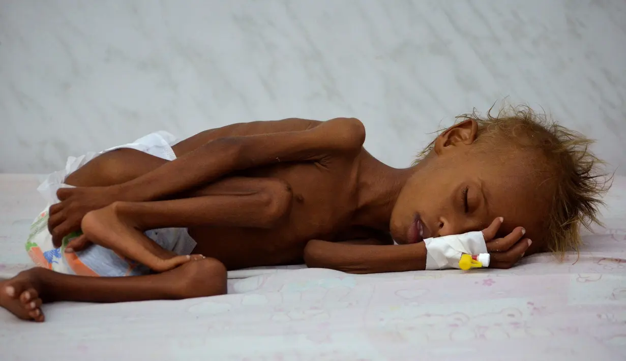 Seorang anak tergeletak di tempat tidur di unit malnutrisi perawatan intensif di sebuah rumah sakit di kota pelabuhan Laut Merah dari Hodaida, Yaman pada 11 September 2016. (REUTERS/Khaled Abdullah)