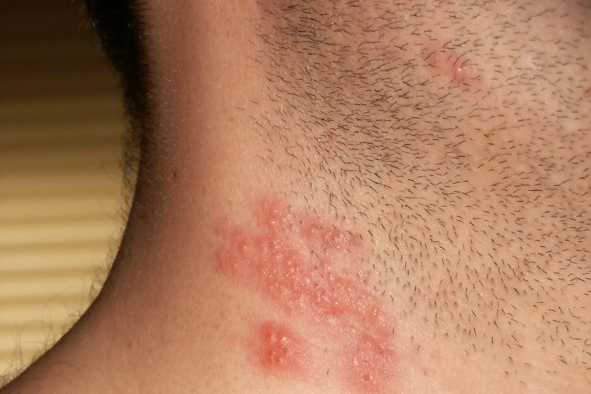Cacar Ular