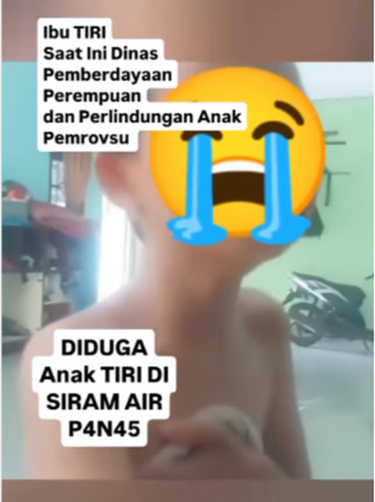 Kejamnya Ibu Tiri Siram Air Panas ke Anak Hingga Kulit Terbakar, Padahal Profesinya ASN Perlindungan Anak