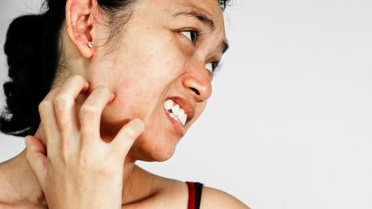 Keluar bintik merah pada kulit? Itu gejala hives!
