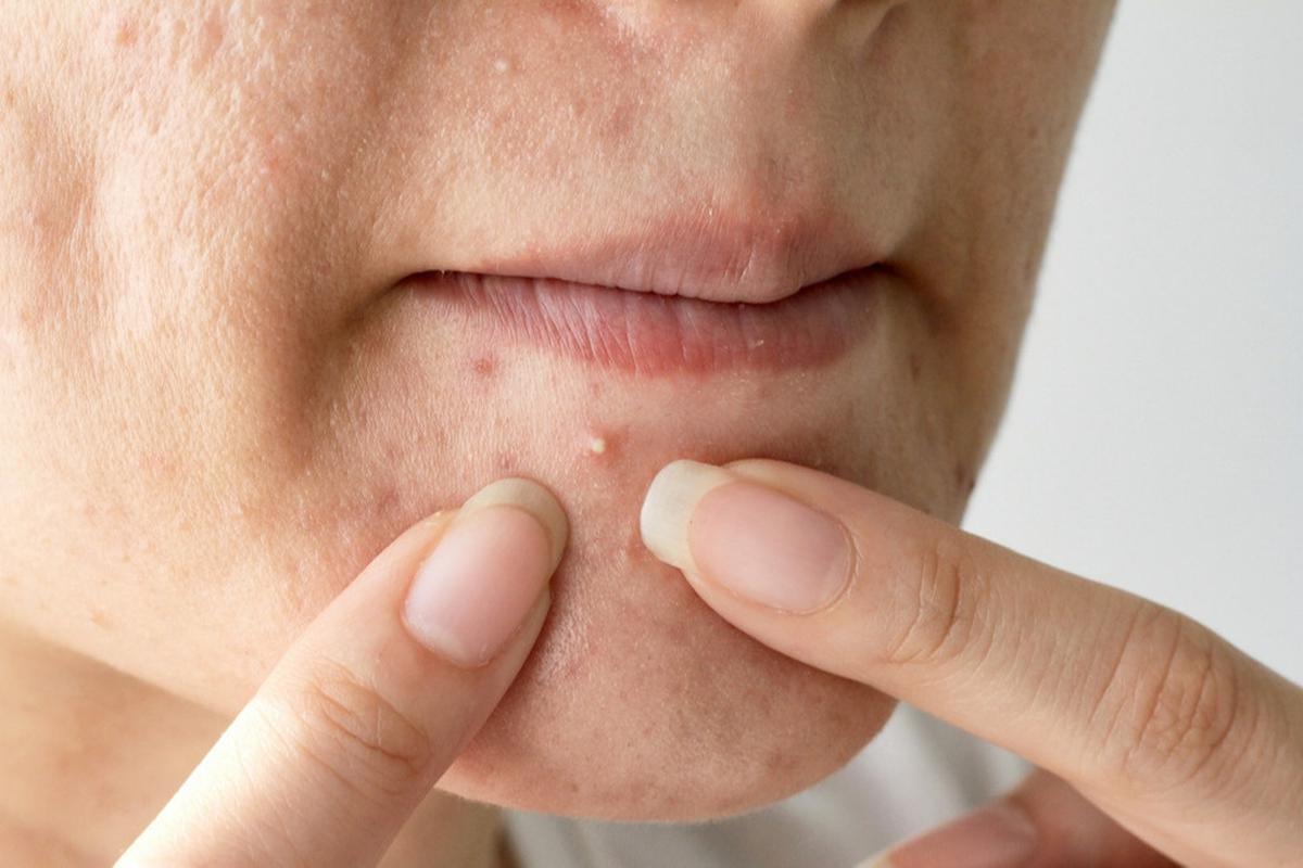Acne Prone Skin