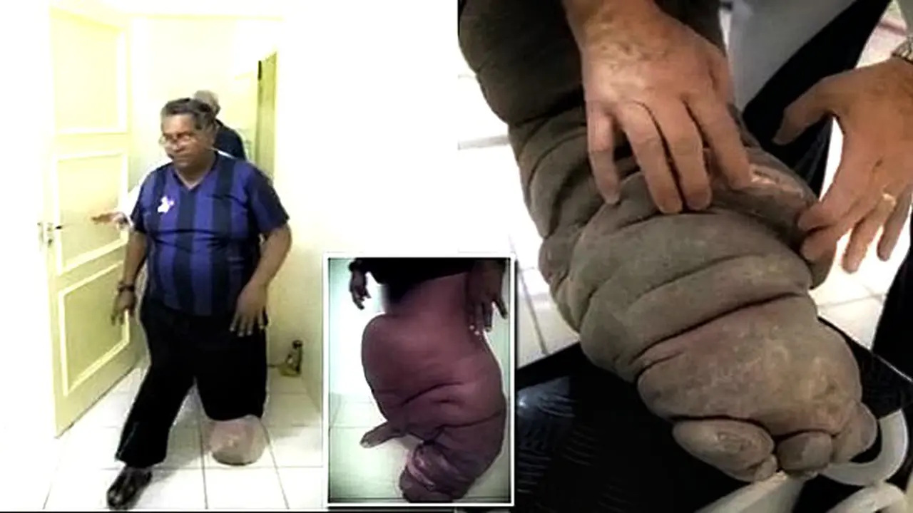 Kena Gigitan Nyamuk 20 Tahun Lalu, Pria Brasil Idap Kaki Gajah 