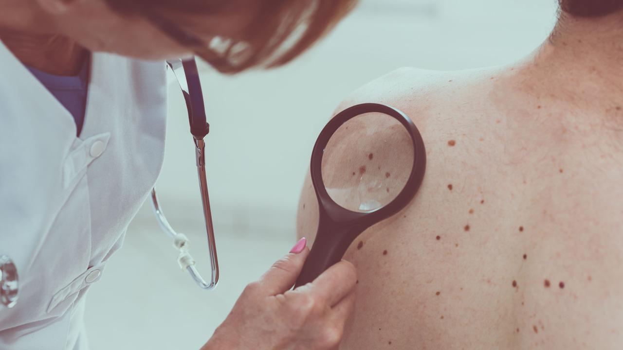 Ilustrasi kanker kulit