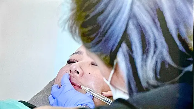 Filler bibir