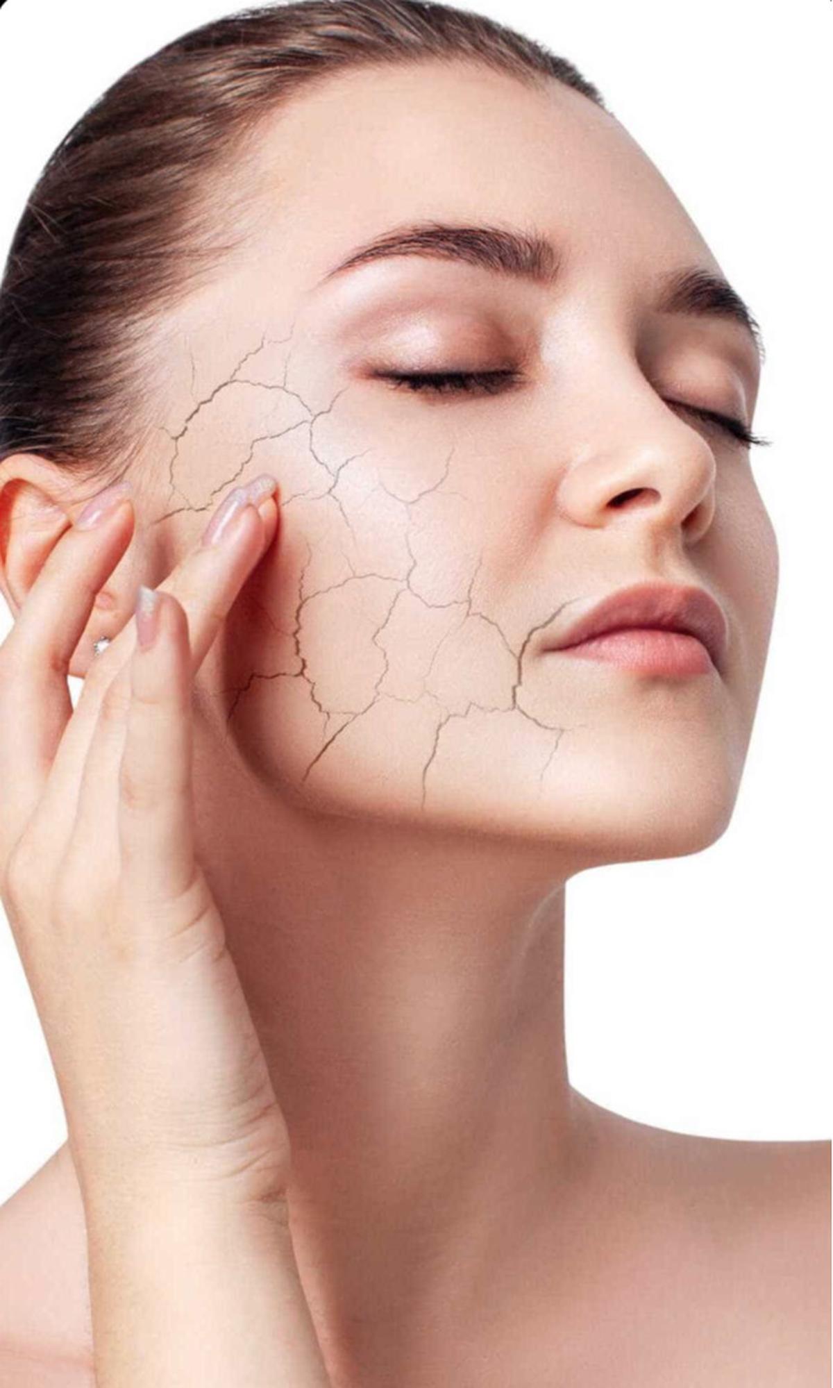 Jangan Biarkan Kulit Kering Mengganggu! 6 Tips Ampuh Atasi Kulit Kering Saat Musim Dingin