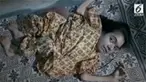 Seorang wanita di India mengalami kelianan tulang, tulangnya terus menyusut sehingga bentuk tubuhnya berubah.