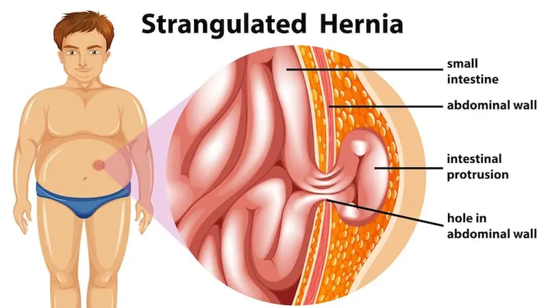 Ilustrasi penyakit hernia