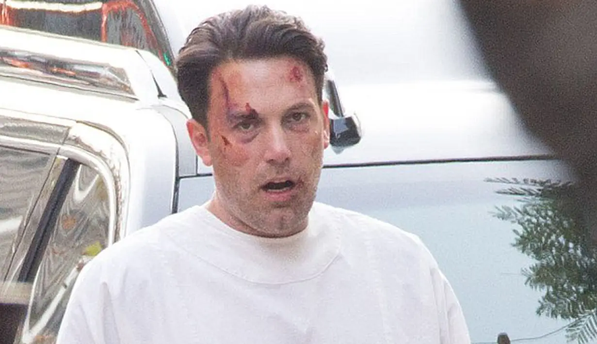 Aktor Hollywood, Ben Affleck tampak babak belur saat berjalan di jalanan kota Los Angeles. Aktor 43 tahun ini mengenakan pakaian pasien rumah sakit dan menjadi sorotan warga sekitar. (Dailymail.co.uk)