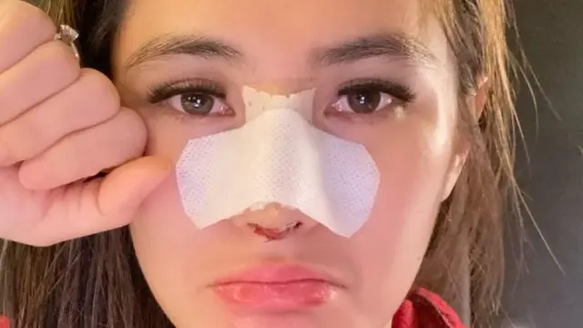 Angela Lee usai menjalani perasi plastik