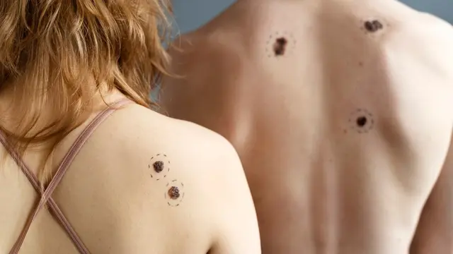 Ilustrasi kanker kulit/freepik.com