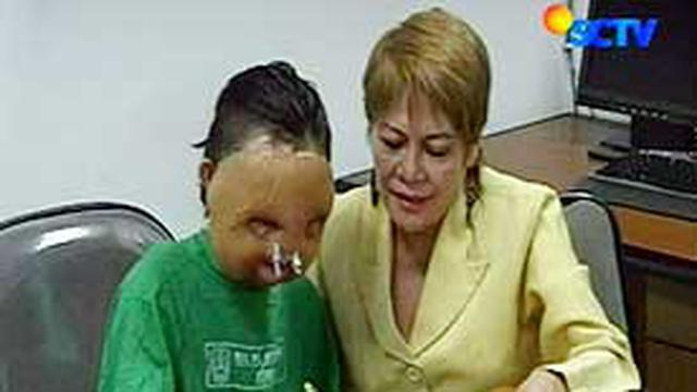 Potret Lisa 14 tahun yang lalu saat menjadi korban penyiraman air keras