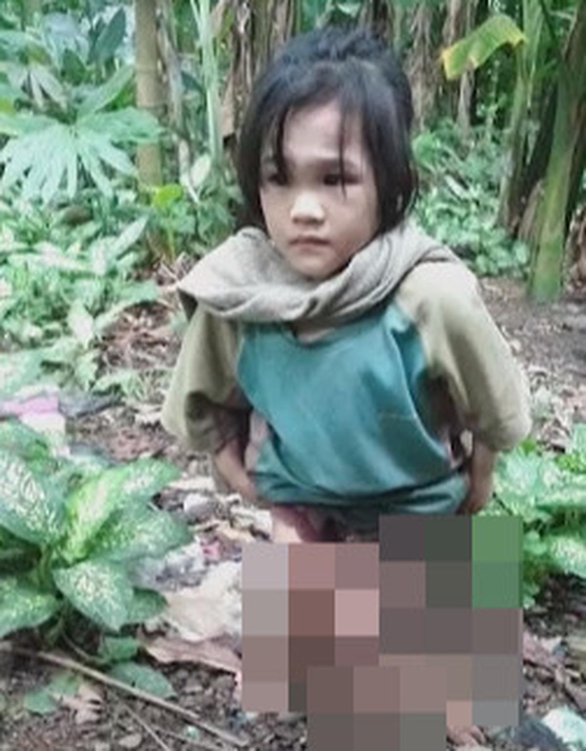 Potret Pilu Bocah Yatim Alami Cacat Fisik hingga Kaki Bengkok