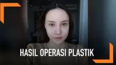 Seorang gadis Thailand menunjukkan tahap-tahap perubahan pada wajahnya setelah menjalani operasi plastik. Wajahnya sempat bengap, terlihat seperti habis kecelakaan. Namun, setelah itu hasilnya pun sungguh menakjubkan!