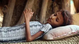 Seorang gadis Yaman yang mengalami gizi buruk terbaring disebuah bangku kayu di desa pesisir yang miskin di pinggiran kota Hodeidah, Yaman (8/4). (AFP Photo/Abdo Hyder)