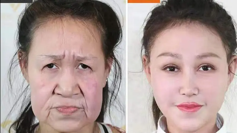 Operasi Plastik, Gadis dengan Penyakit Langka Menangis Haru Lihat Wajah Barunya