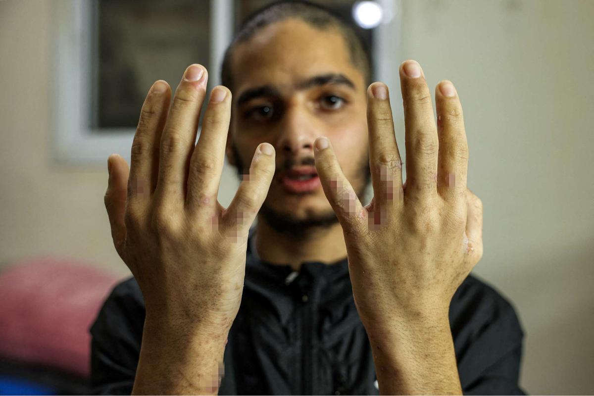 Terungkap Kondisi Miris Tahanan Palestina usai Dibebaskan Israel, Tubuh Kurus dan Penuh Kudis