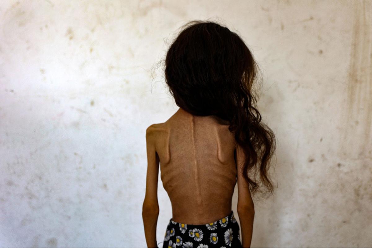 FOTO: Potret Pedih Mariam Anak 9 Tahun, Korban Kelaparan Gaza