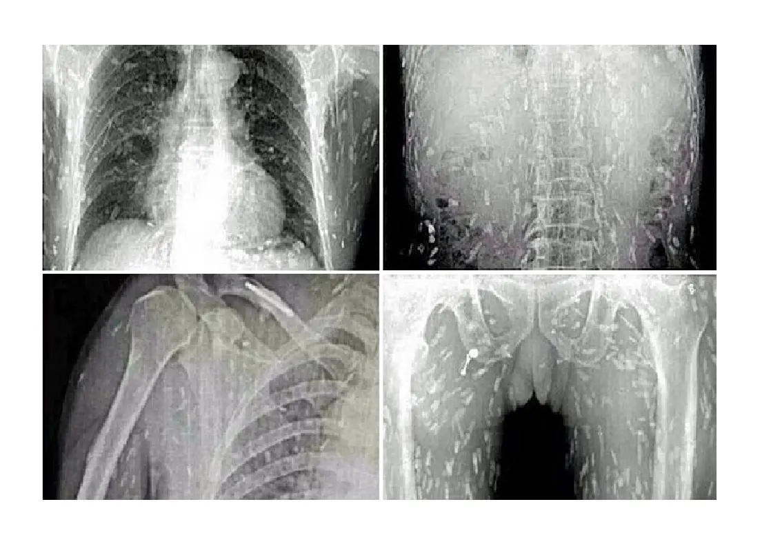 Gambar x-ray penikmat sashimi.terinfeksi cacing pita. (Youtube)