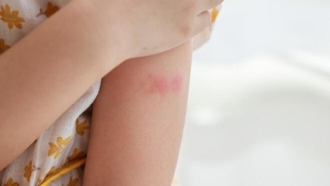 Ketahui Penyebab dan Cara Mengatasi Toasted Skin Syndrome atau Sindrom Kulit Terpanggang