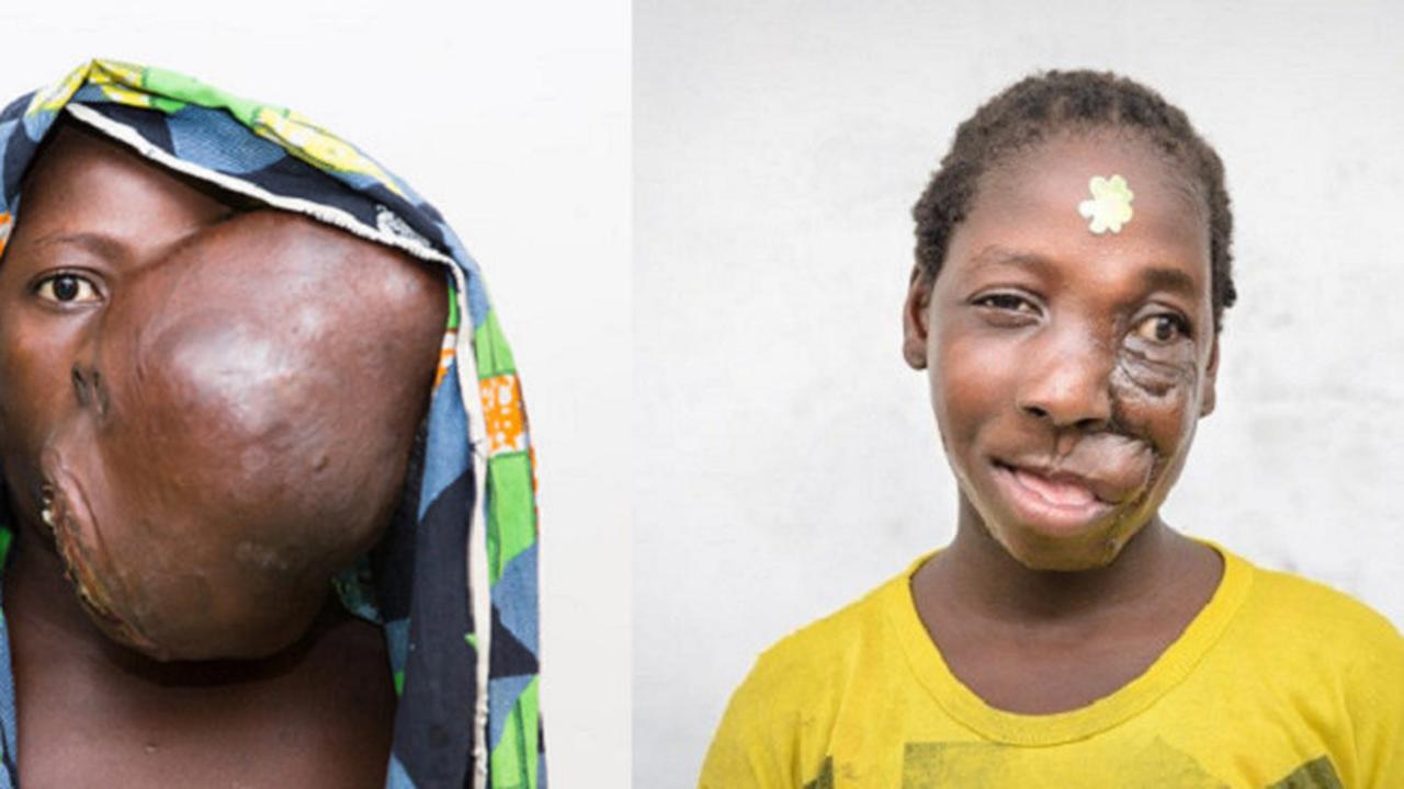 Transformasi Drastis Gadis dengan Tumor Wajah Setelah Dioperasi