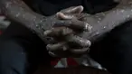 Seorang pria penderita mpox menunggu perawatan di Rumah Sakit Umum Kamituga di Kivu, Kongo Selatan, Rabu (4/9/2024). (AP Photo/Moses Sawasawa)