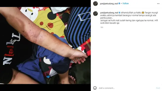 Ular Nyasar Masuk Rumah Gigit Anak Panji Petualang, Ini 6 Potret Kondisinya Sekarang