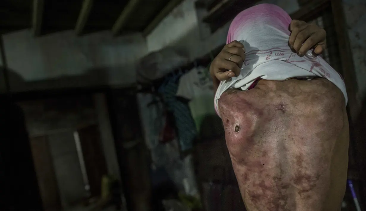 Khin Khin Tun memperlihatkan Bekas luka dibagian punggung di Mawlamyine (13/2). Khin Khin Tun disiksa oleh majikannya yang bernama  Aye Aye Soe tega. (AFP PHOTO/YE AUNG THU)