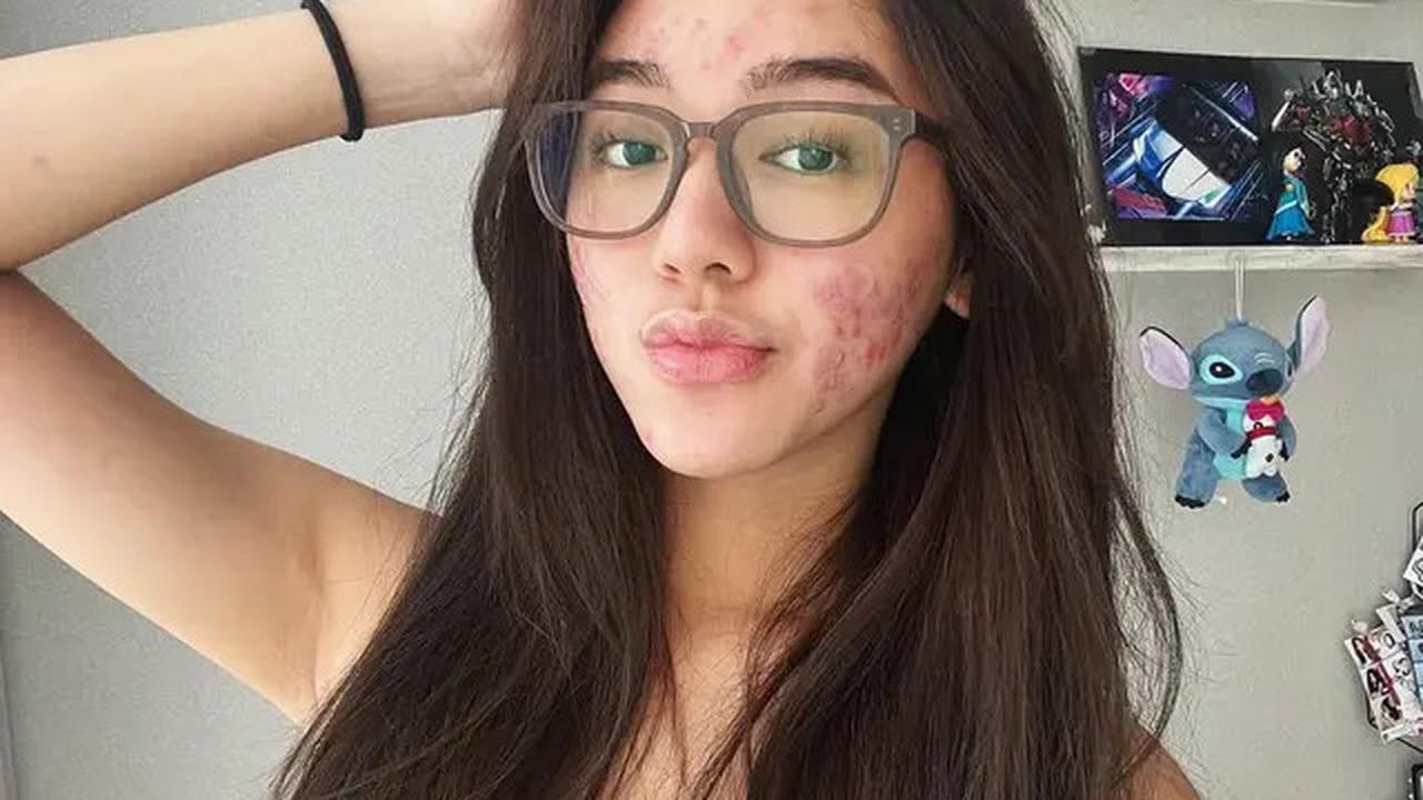 6 Potret Wajah Gabriella Ekaputri Berjerawat, Tetap Percaya Diri Tampil Natural