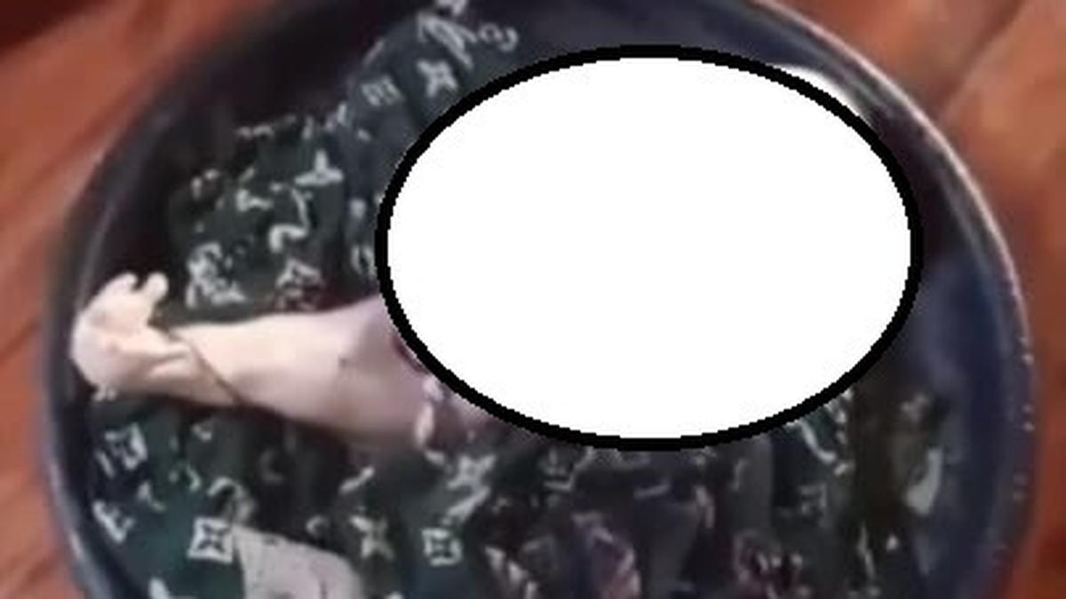 Viral Bayi dengan Kaki Menyatu di Sumatera Selatan, Begini Penjelasannya