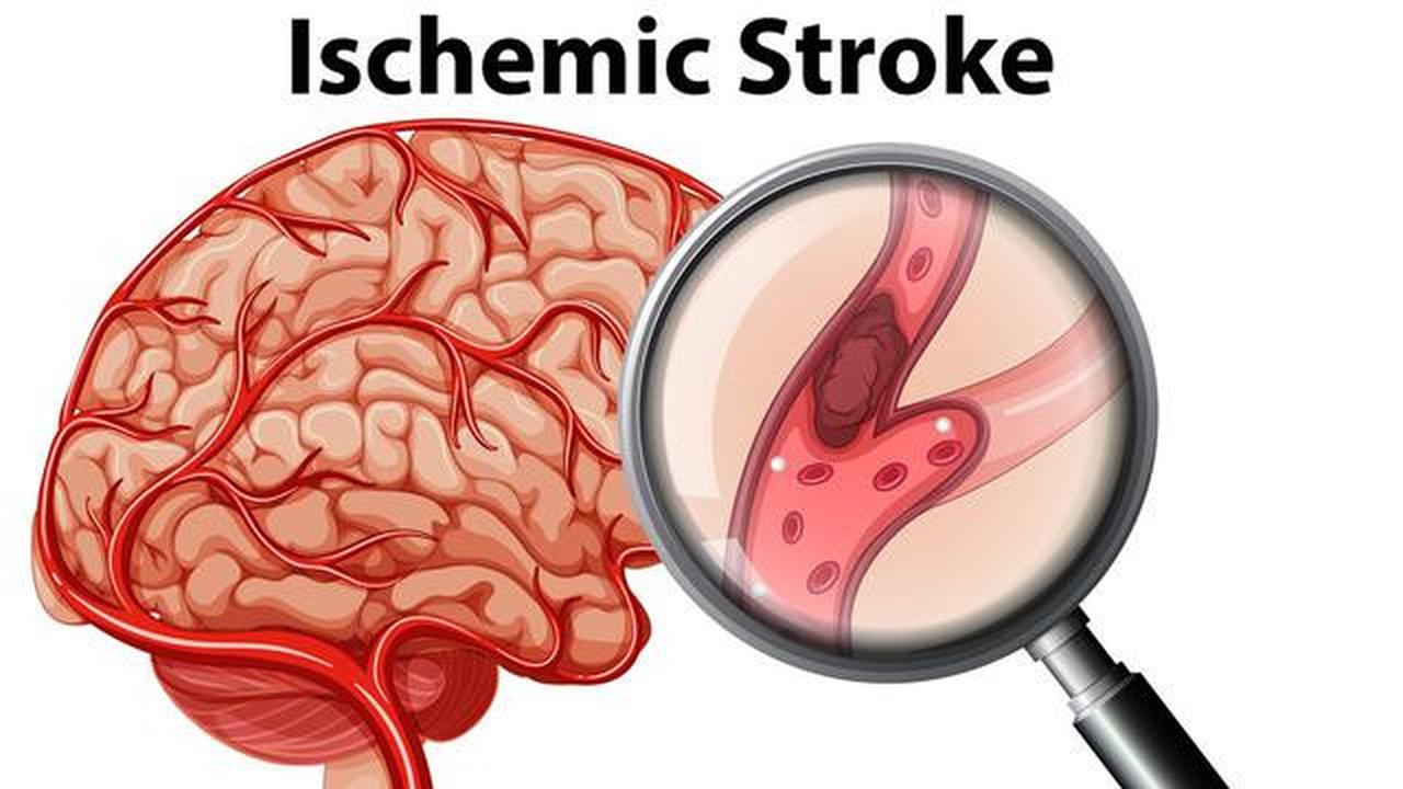 Kenali Risiko Stroke Sejak Dini, Begini Gejala dan Cara Penanganannya