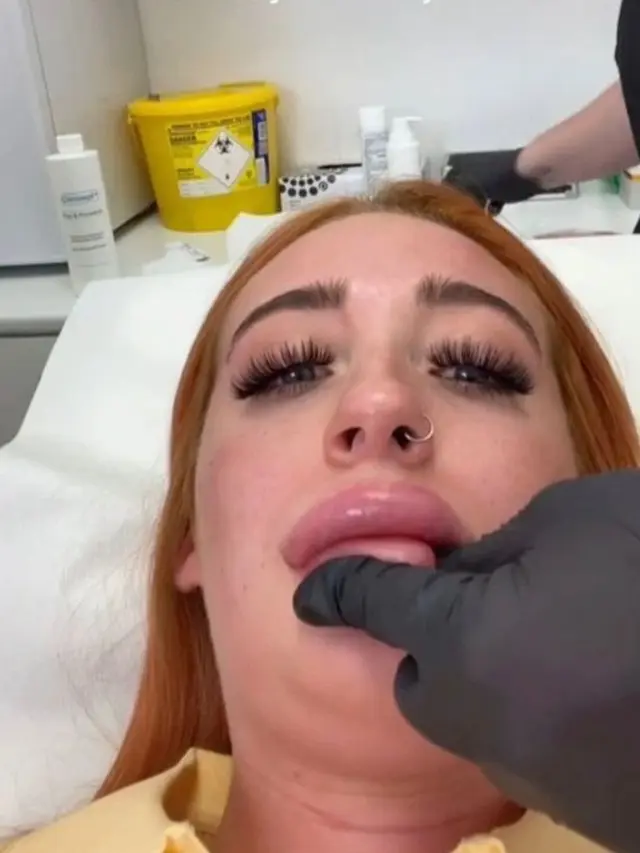 Lauren Faulkner yang viral setelah bibir bengkaknya akibat Filler(Image: Lauren Faulkner/TikTok)