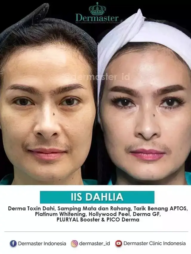 Potret Iis Dahlia sebelum dan sesudah tanam benang (Sumber: Instagram/dermaster_id)