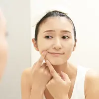 Ilustrasi jerawat/copyright shutterstock